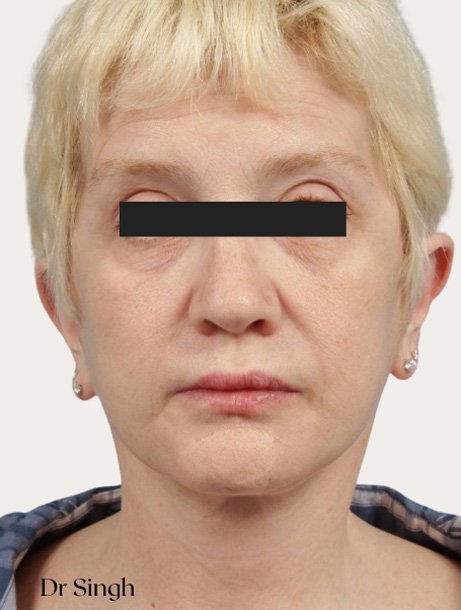 face lift after picture